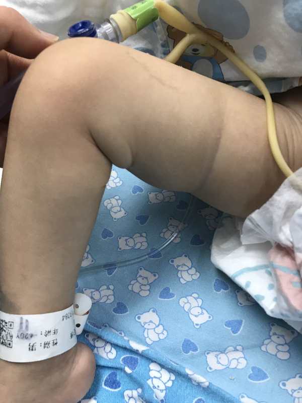 3岁捐献者心脏置换给1岁婴儿,华南地区最低龄"换心术"成功了