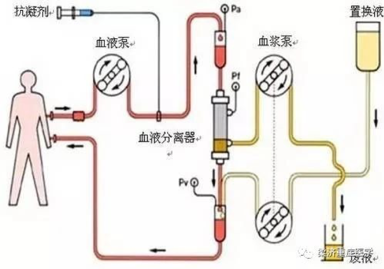 血浆置换工作原理图.
