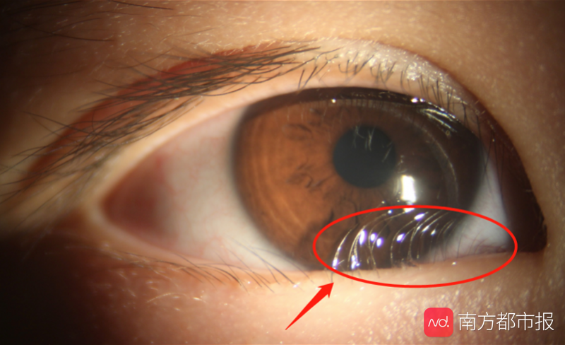 睫毛倒长会引起角膜损伤专家:可千万别拔,得手术矫正