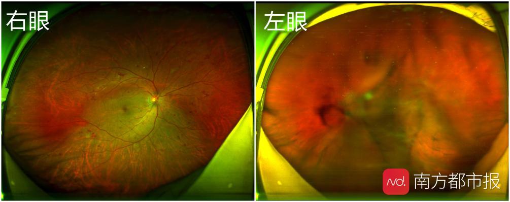5的視力,但是眼底狀況並不理想,存在全視網膜散在出血點,黃斑區中心凹