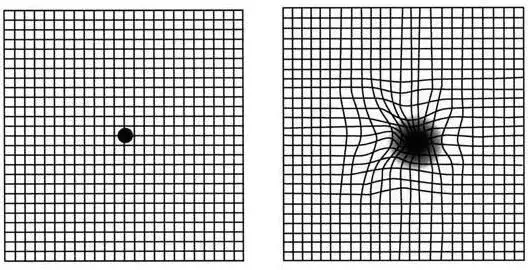 当发现眼睛出现视力下降,视物变形等症状时,应警惕黄斑病变,尽快到